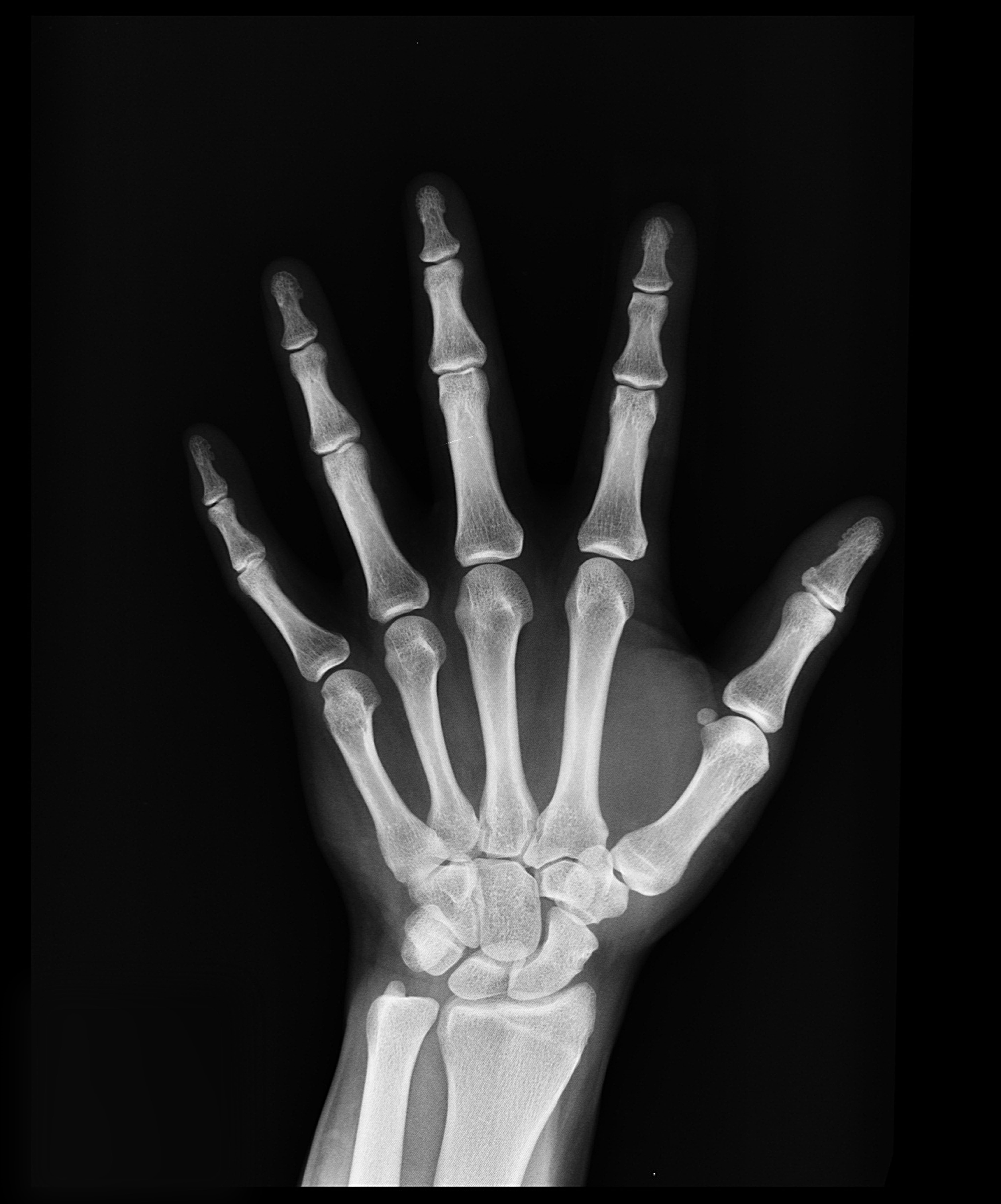 diagnosis, people, human body part, body part, human limb, wrist, human Hand, medical x-ray, hand, health, medicine, black background, indoors, human finger, Phone HD Wallpaper
