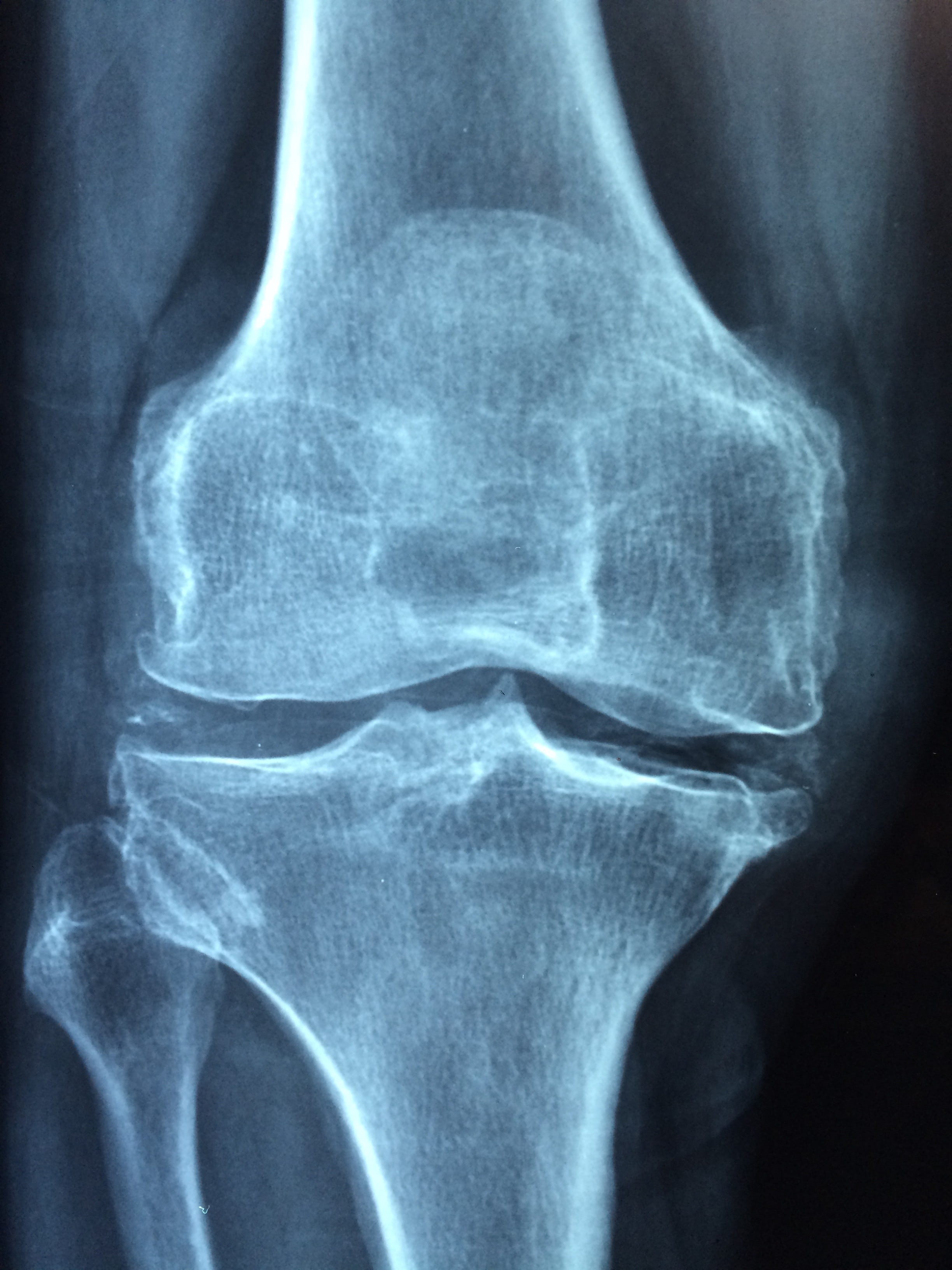healthcare and medicine, x-ray image, hospital, human body part, radiologist, knee pain, human joint, human skeleton, limb, results, human limb, inflammation, Phone HD Wallpaper