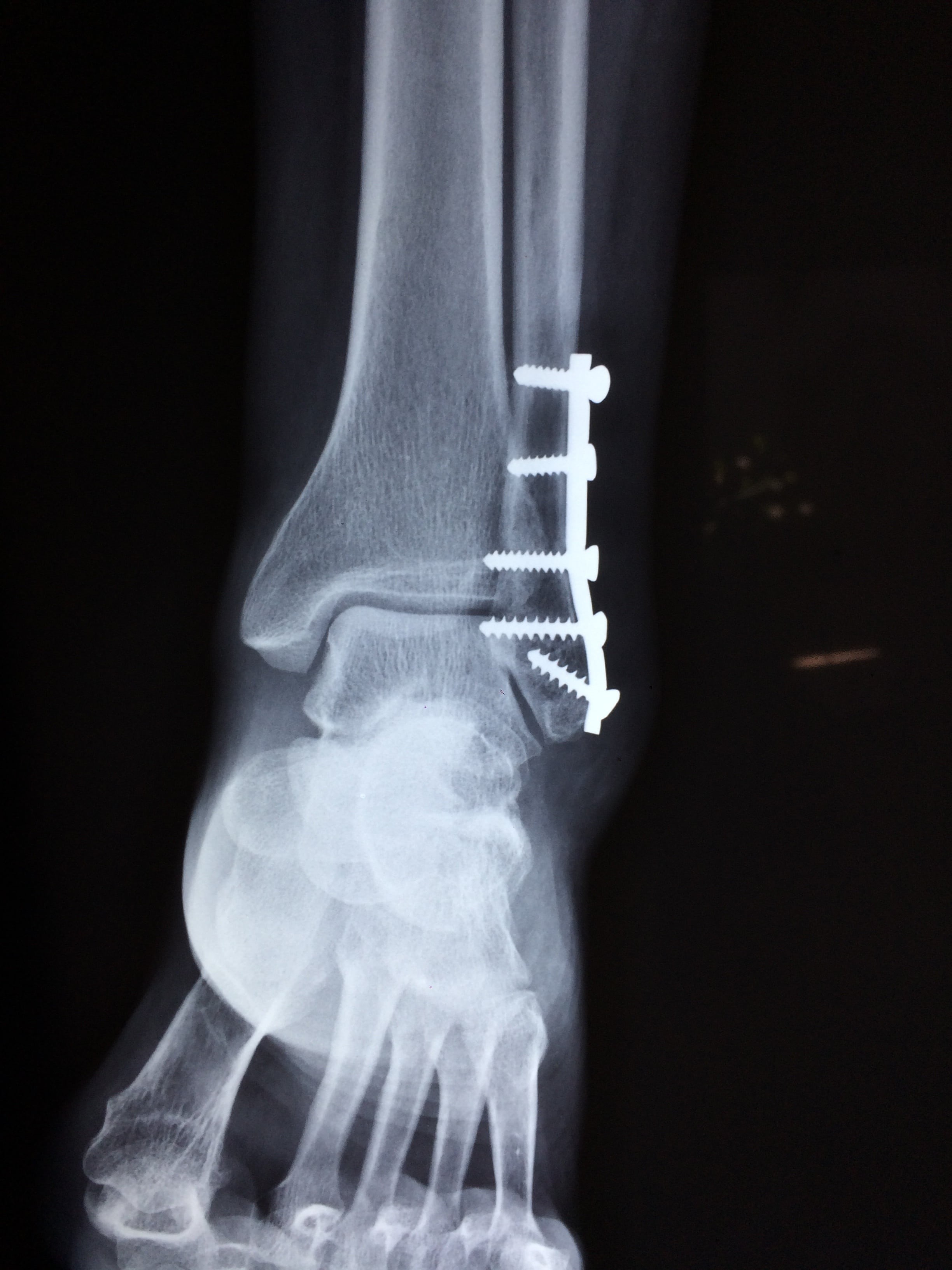 human bone, physical injury, skeleton, medical x-ray, surgery, doctor, patient, bone, medical, finger, wrist, people, joint - body part, accident, human skeleton, Phone HD Wallpaper