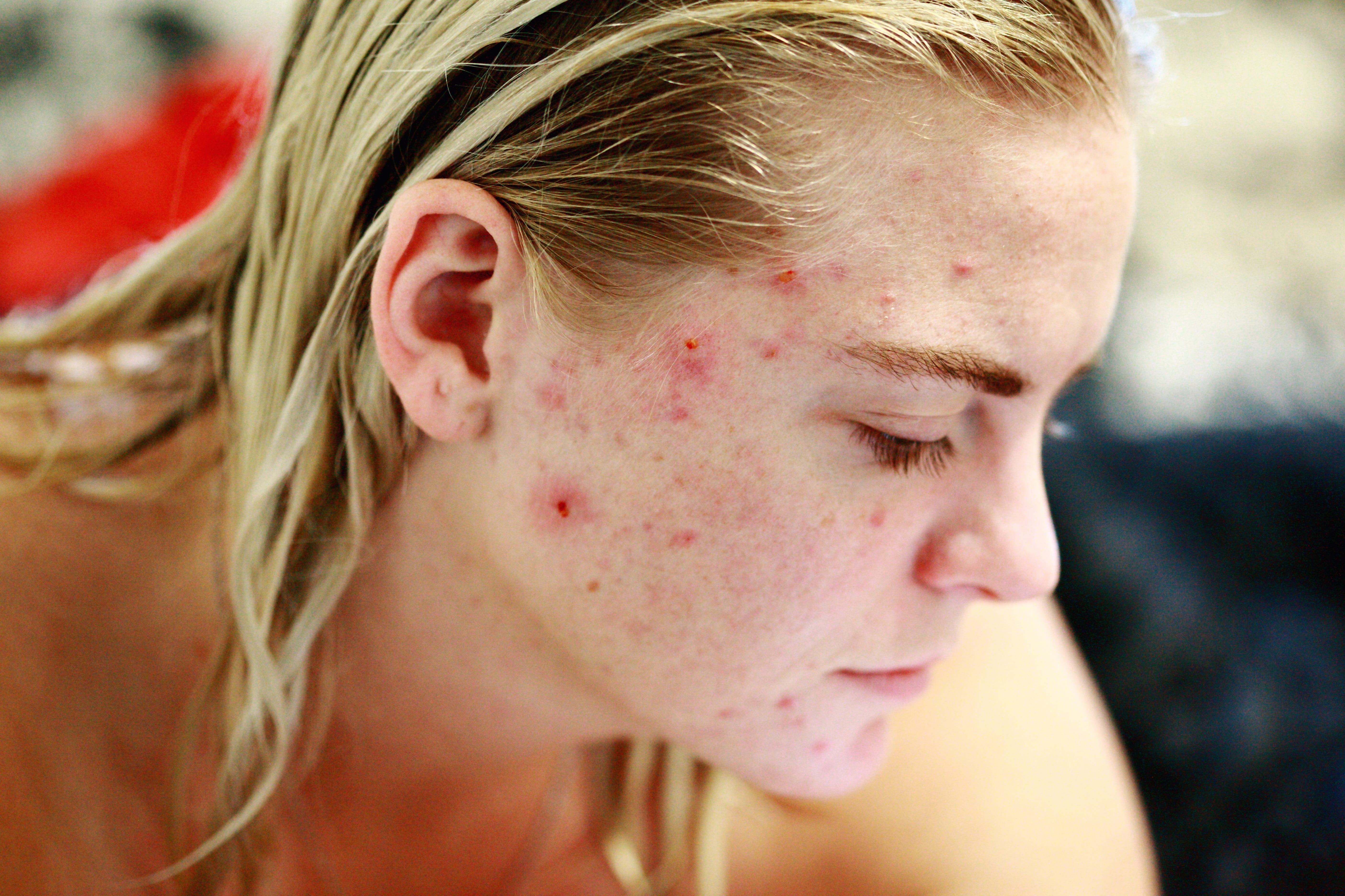 human face, blemishes, teenager, acne, problems, caucasian, child, hairstyle, human, bruise, girls, portrait, model, freckle, 5K, character, people, issues, HD Wallpaper