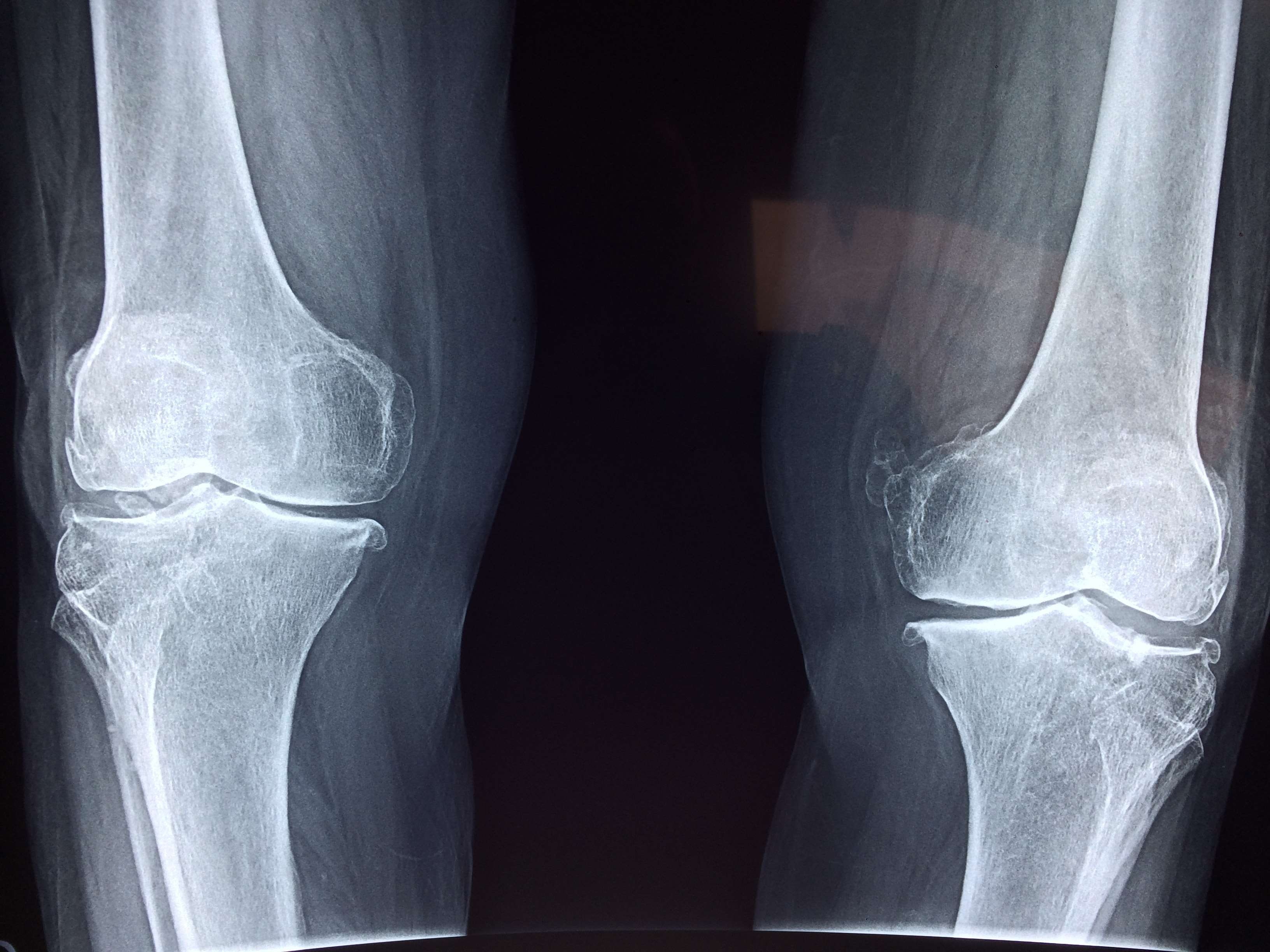 disease, knee, medical condition, x ray, black background, 2K, x-ray image, human skeleton, therapist, medical, human bone, human body part, hospital, HD Wallpaper