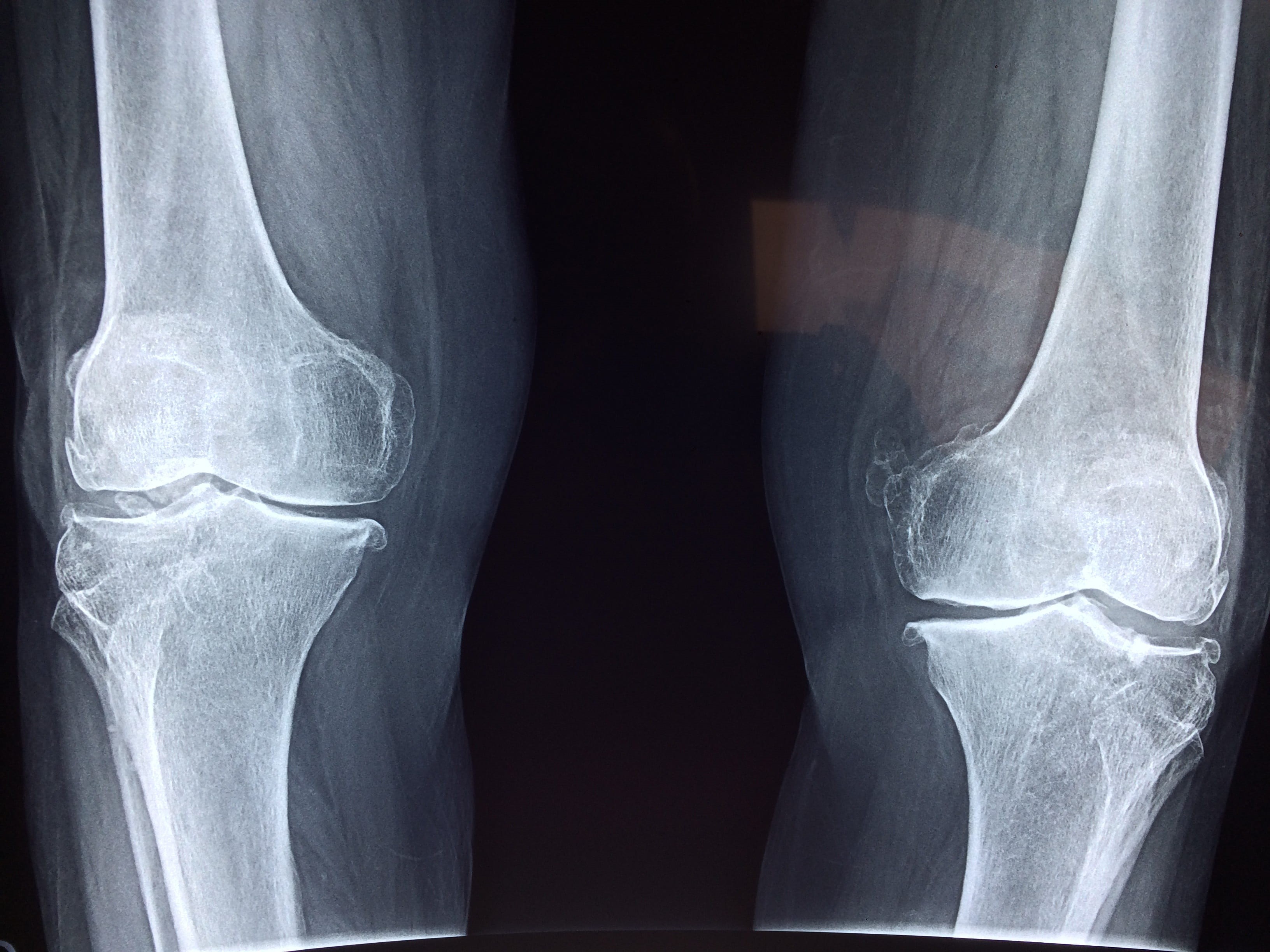 human limb, x-ray, science, healthcare and medicine, people, illness, x-ray image, bone, medical x-ray, medical, joint - body part, knee, orthopedic, cartilage, HD Wallpaper