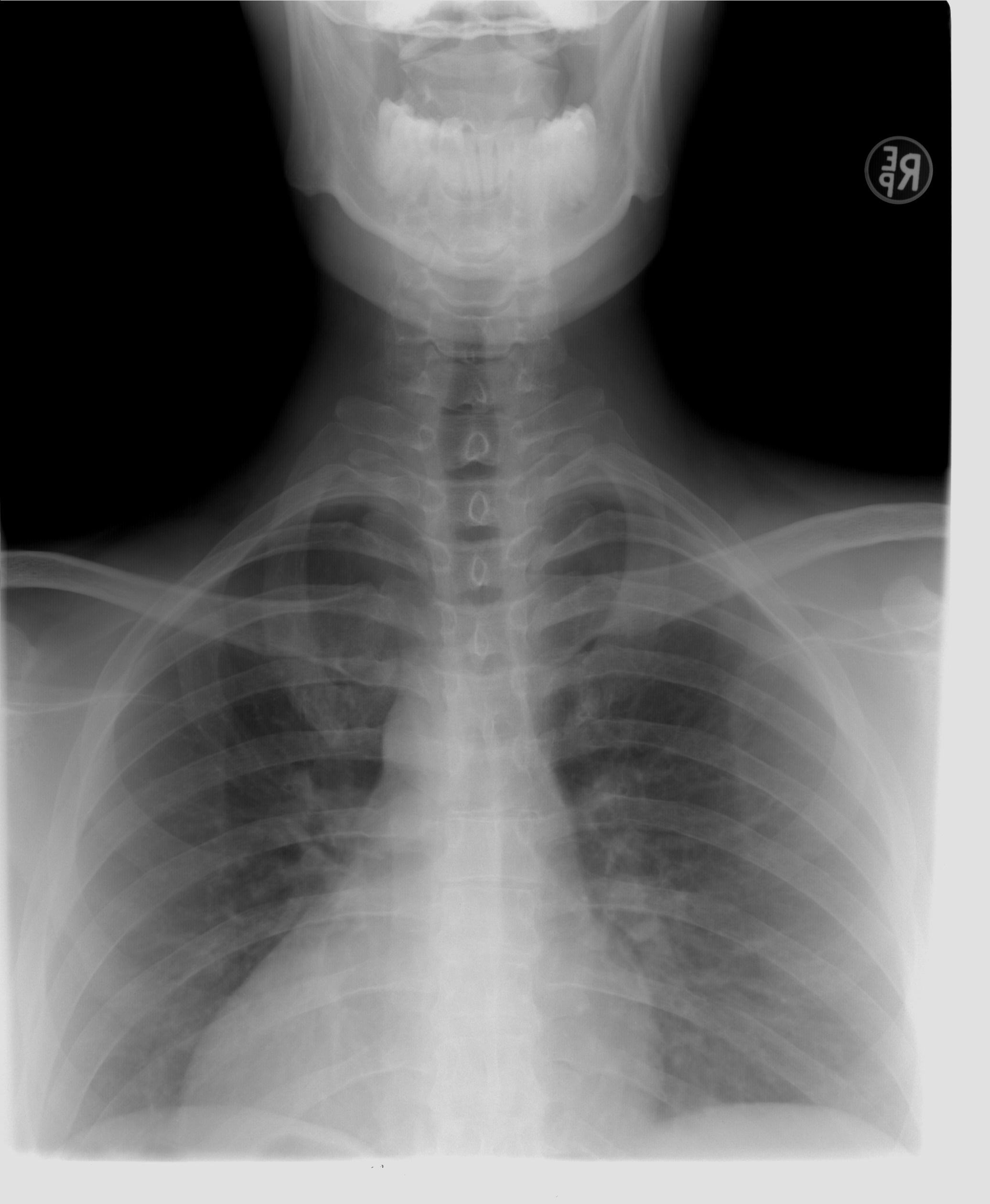 medical condition, bone, x, x-ray image, front view, ray, human bone, people, xray, illness, human body part, indoors, diagnosis, human skeleton, thoracic spine, Phone HD Wallpaper