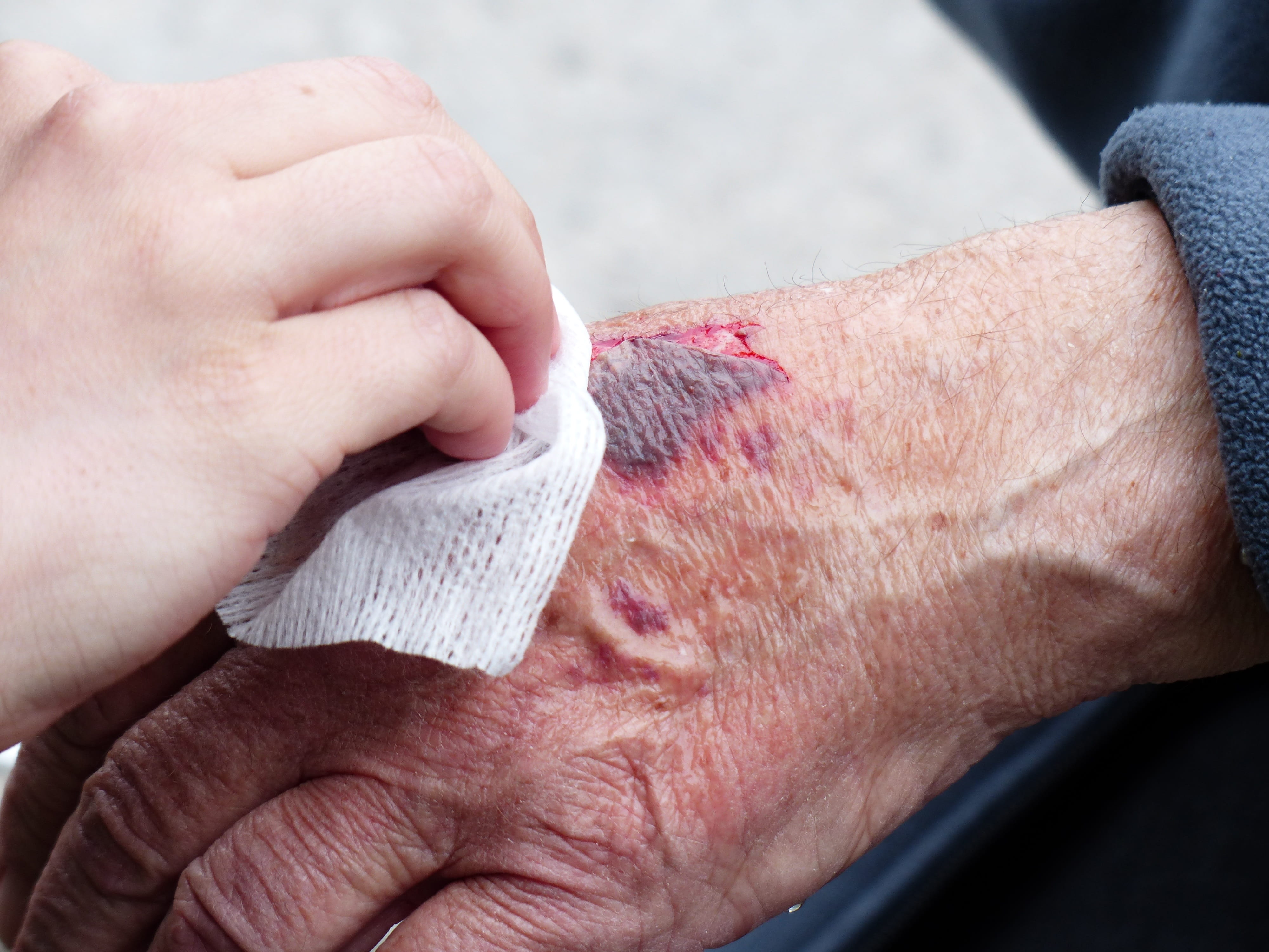 real people, accident, leathers off, human limb, ablederung, healthcare and medicine, physical injury, Injury, person, back of the hand, Hand, disinfection, HD Wallpaper