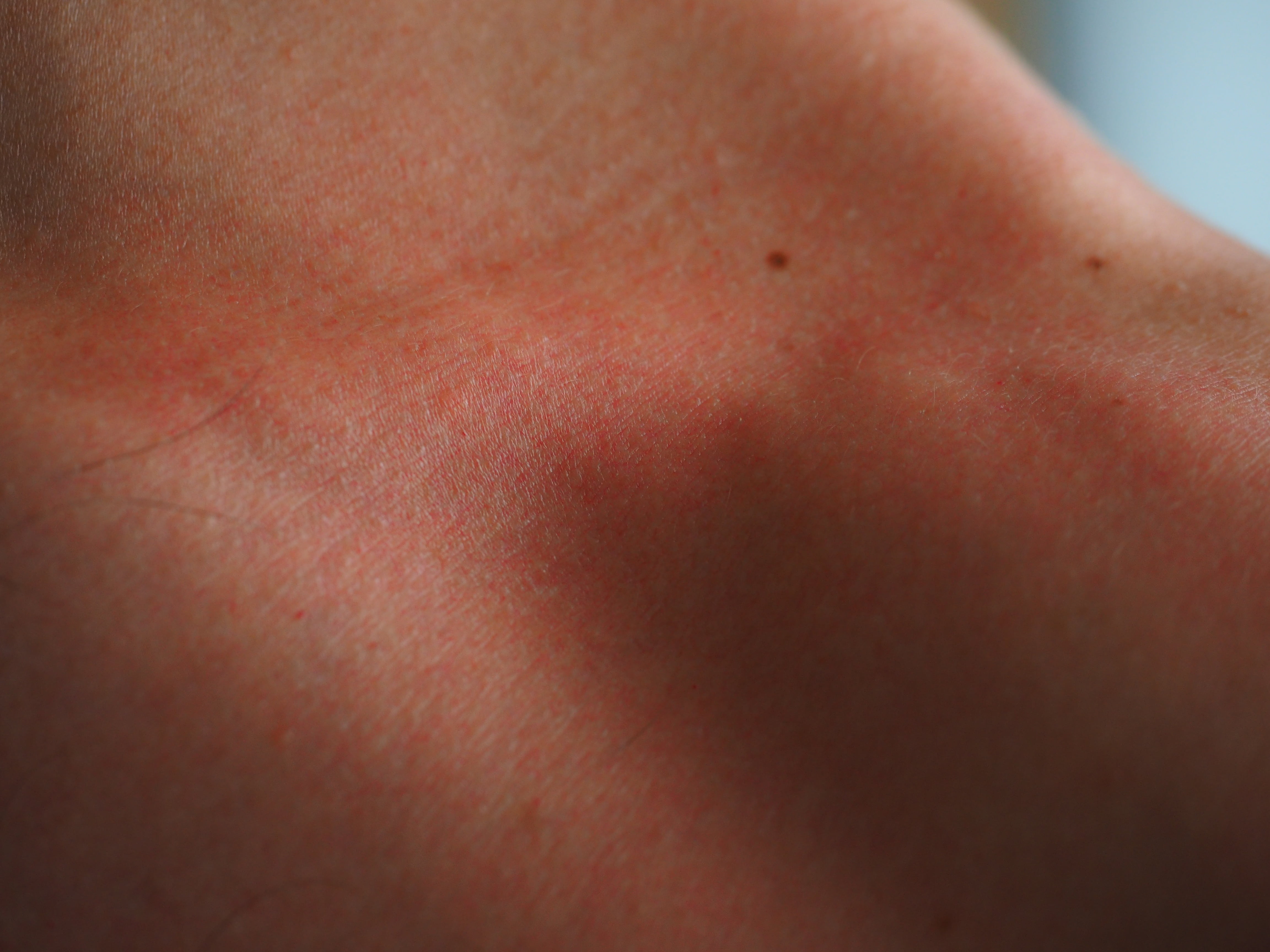 human limb, pain, red, flushed, shirtless, adult, heat, human face, sunburn, extreme close-up, risk, burned, human body part, unrecognizable person, lifestyles, HD Wallpaper