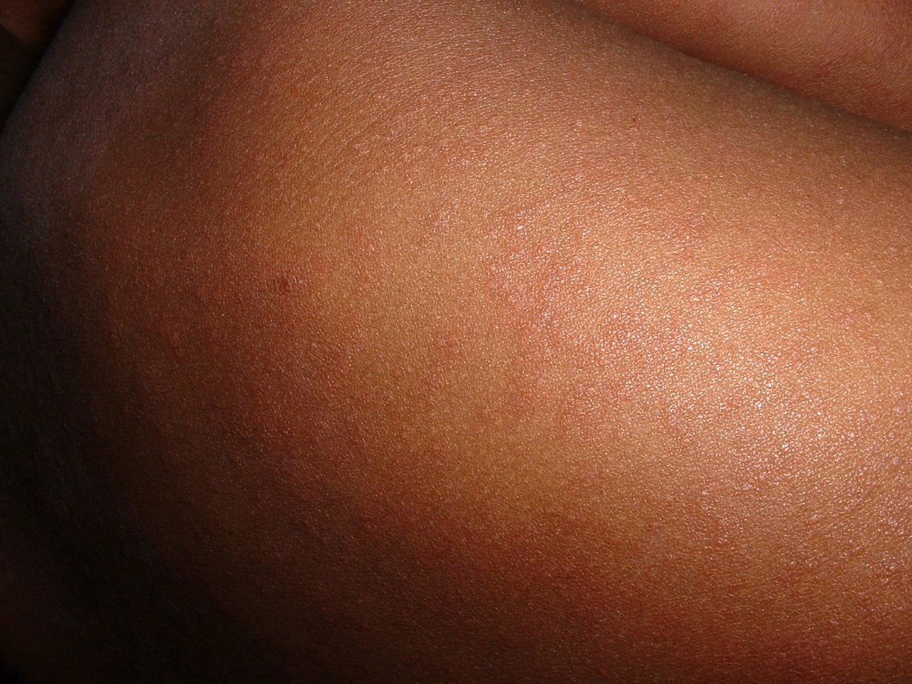 virus, infectious disease, one person, skin, vaccination, children, body part, indoors, women, beauty, human body part, exanthema, human abdomen, infection, HD Wallpaper
