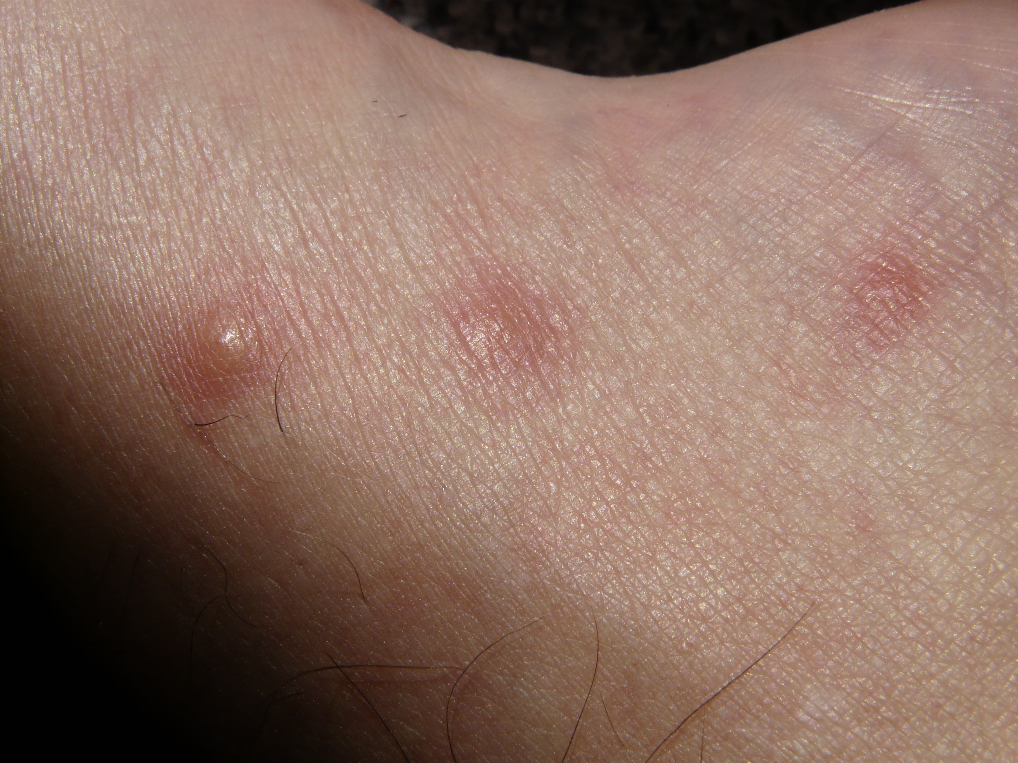 redness, unrecognizable person, close-up, 2K, wheal, hand, itching, schnakenstiche, adult, human hair, macro, allergic reaction, condition, histamine, HD Wallpaper