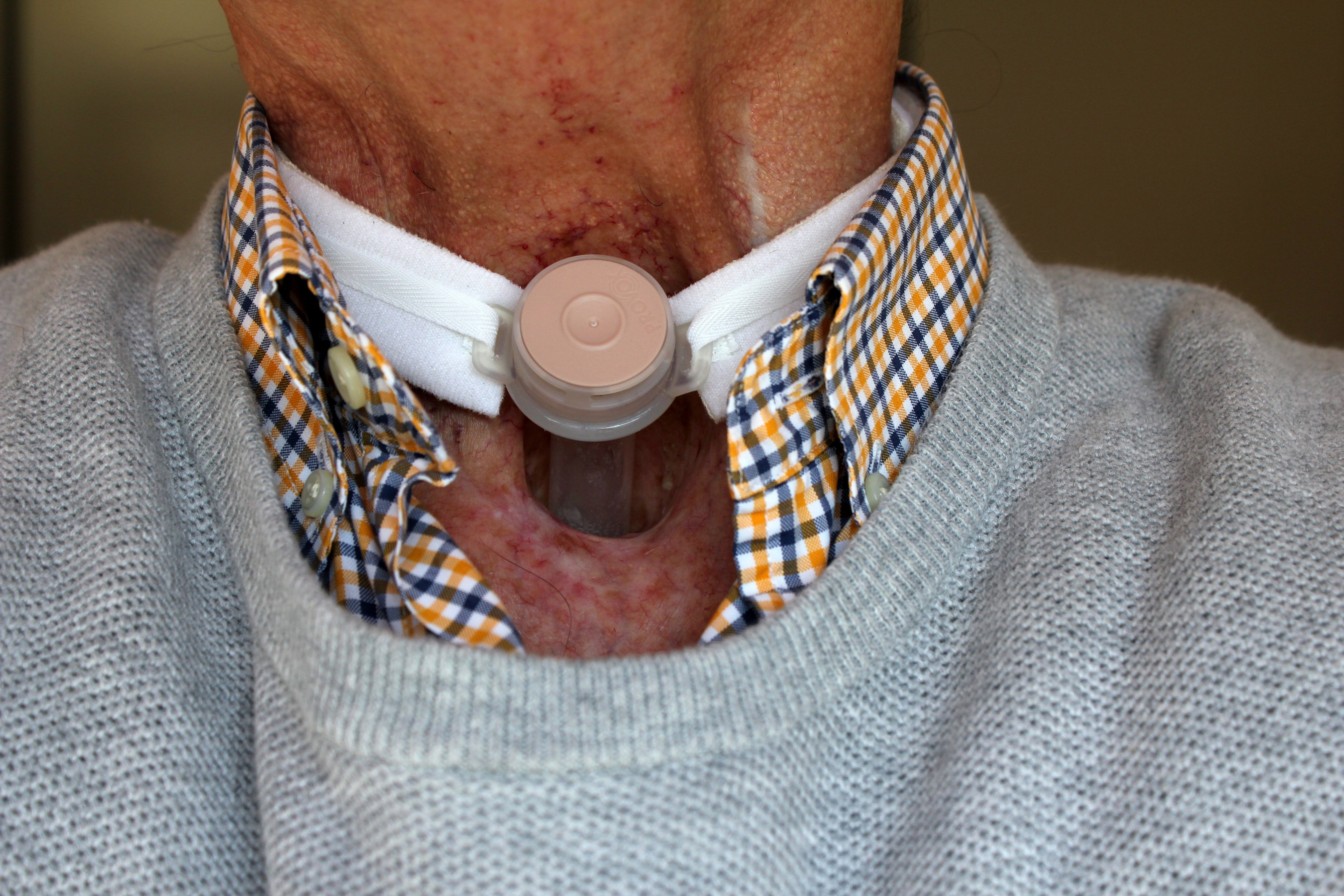 patient, adult, surgical, illness, healthcare and medicine, technology, tube, hospital, tracheostomy, tracheotomy, surgery, real people, respiratory, males, HD Wallpaper