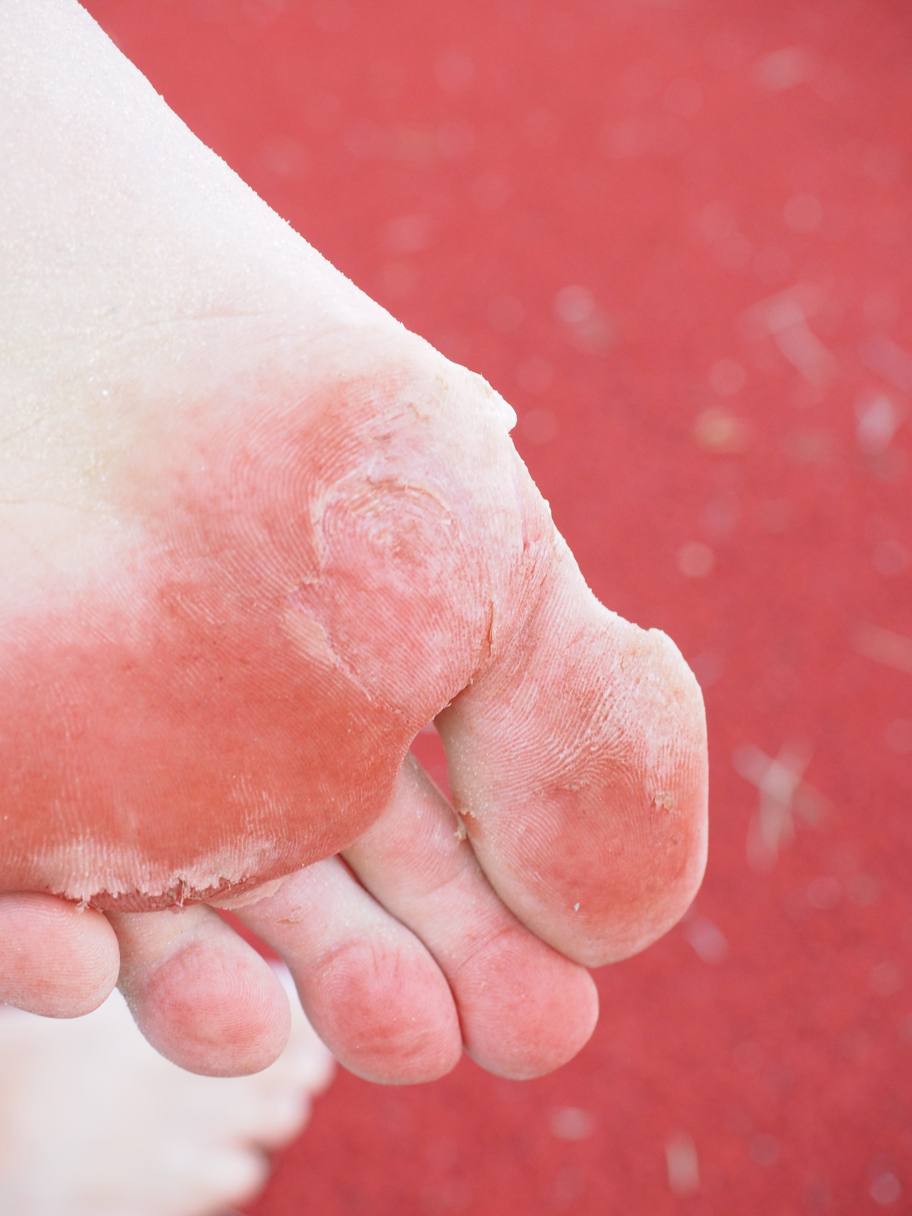 injured, nature, Bubble, foot, people, hand, ill, condition, athletes foot, Sole Of The Foot, wound, Cornea, abrasion, day, holding, foot disease, high angle view, Phone HD Wallpaper