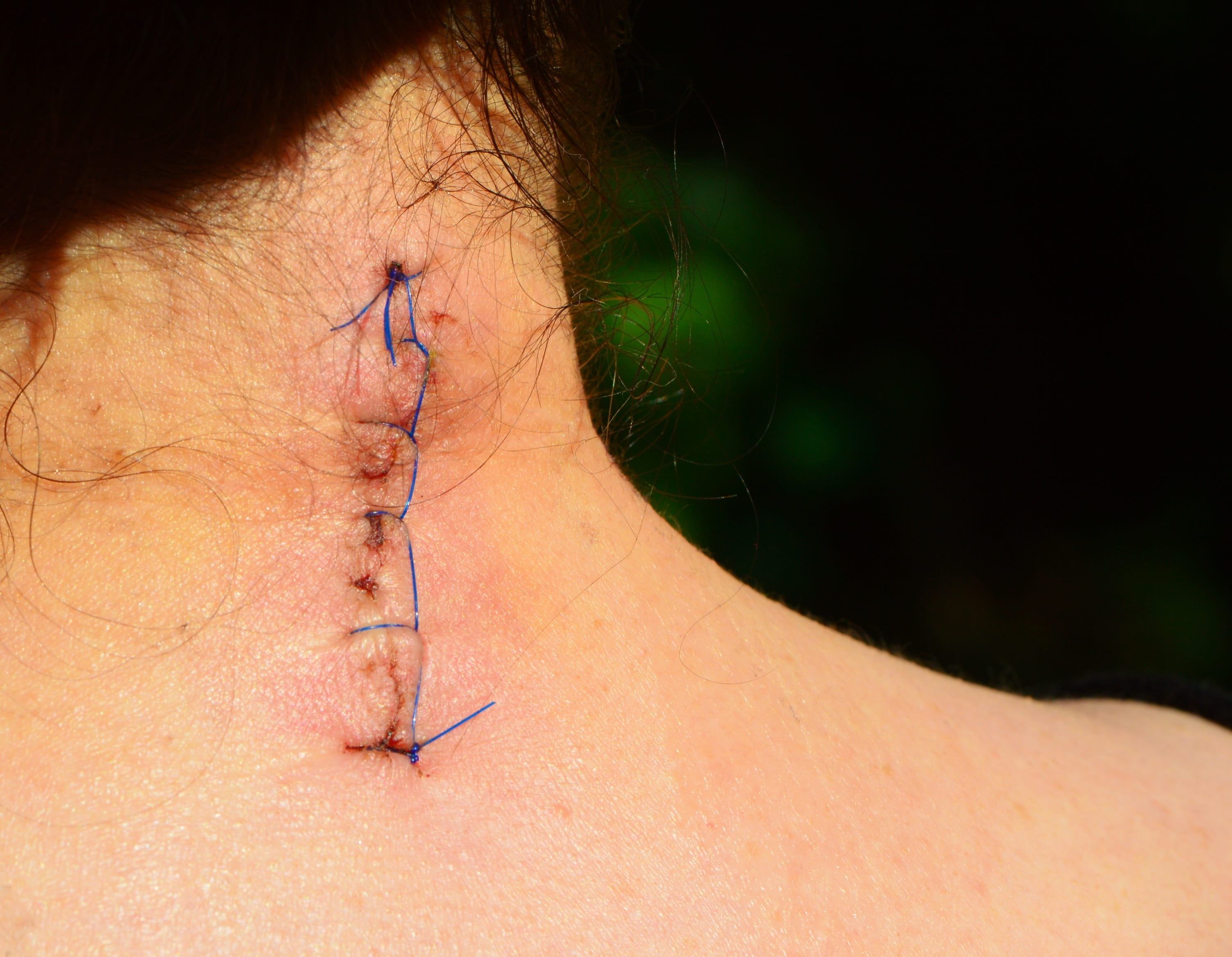 sewn, real people, human face, close-up, shirtless, c6 c7, pain, human skin, intervertebral discs, stitched, neck, one animal, person, nature, invertebrate, HD Wallpaper