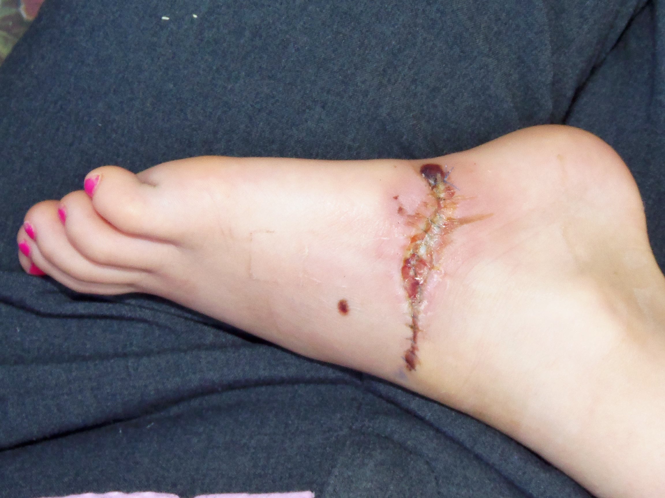 human foot, yuck, real people, physical injury, misfortune, skin, surgery, human leg, close-up, recovery, painful, 1080P, blood, medical, human hand, stitches, HD Wallpaper