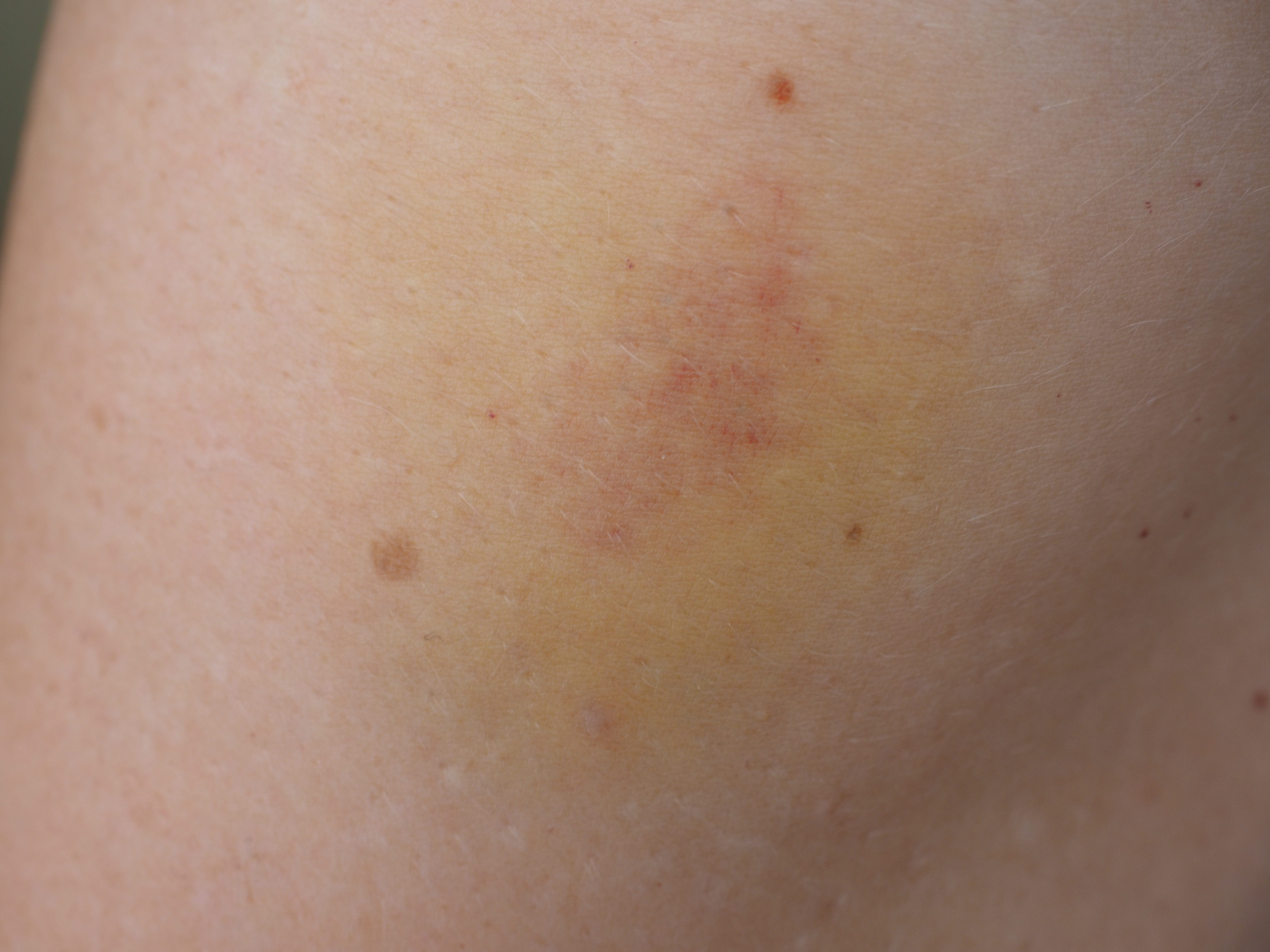 recovery, haematoma, body part, blue blot, pain, full frame, 4K, backgrounds, indoors, injury, physical injury, hematoma, medical condition, human limb, HD Wallpaper
