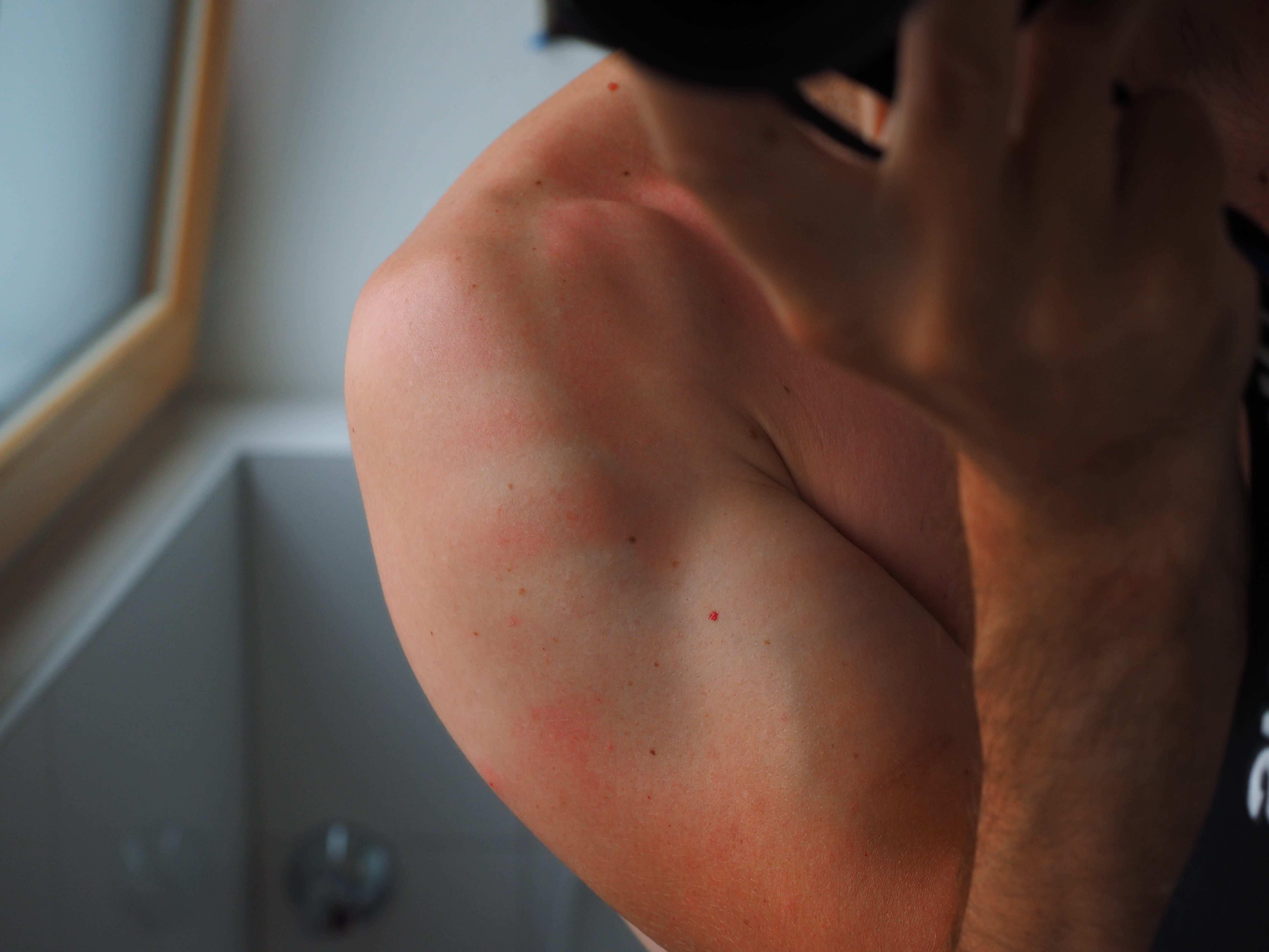 domestic room, human skin, shirtless, risk, right, body part, lifestyles, human limb, chest, one person, redness, focus on foreground, young adult, semi-dress, HD Wallpaper