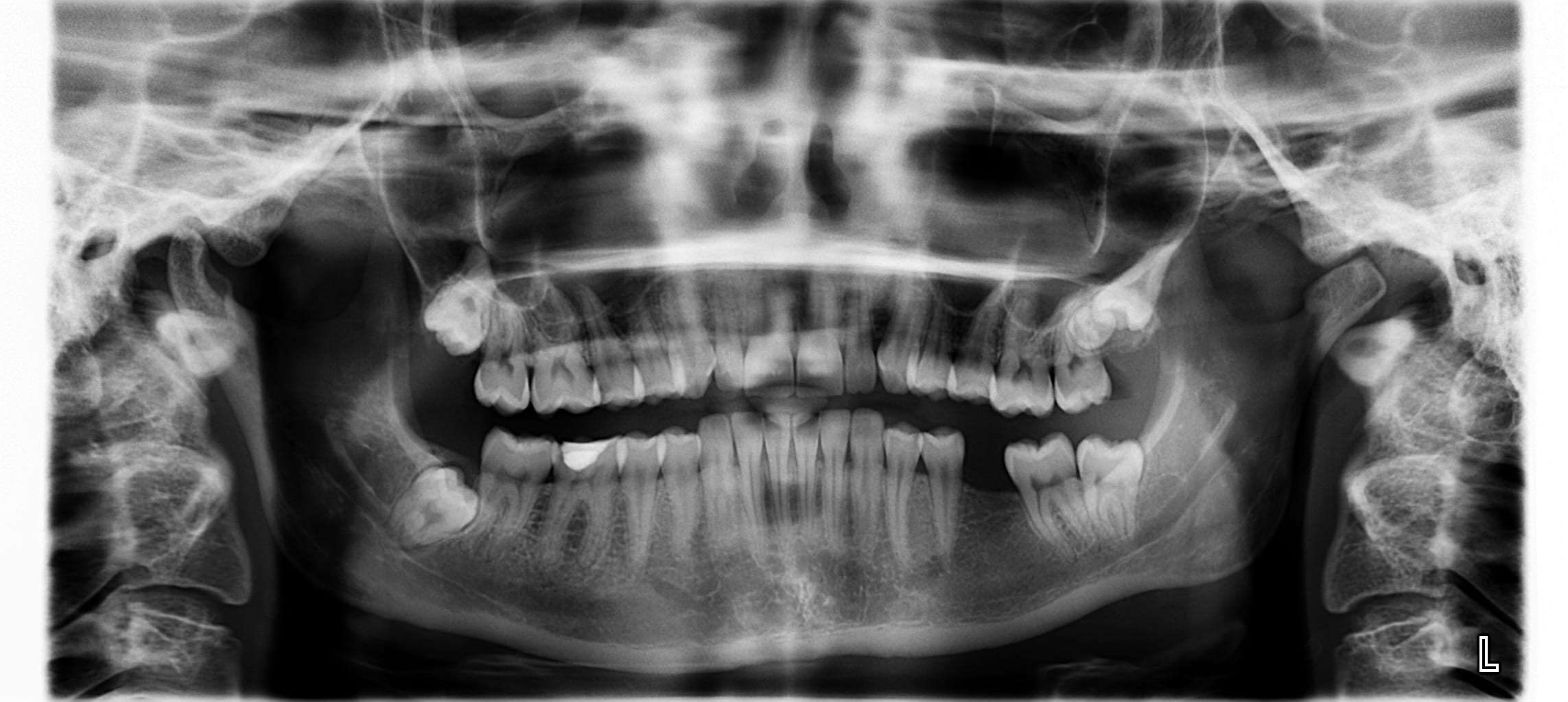 teeth, x, human teeth, ray, people, human bone, mouth open, horror, human mouth, fear, x-ray image, front view, x ray, spooky, emotion, bone, ominous, body part, HD Wallpaper
