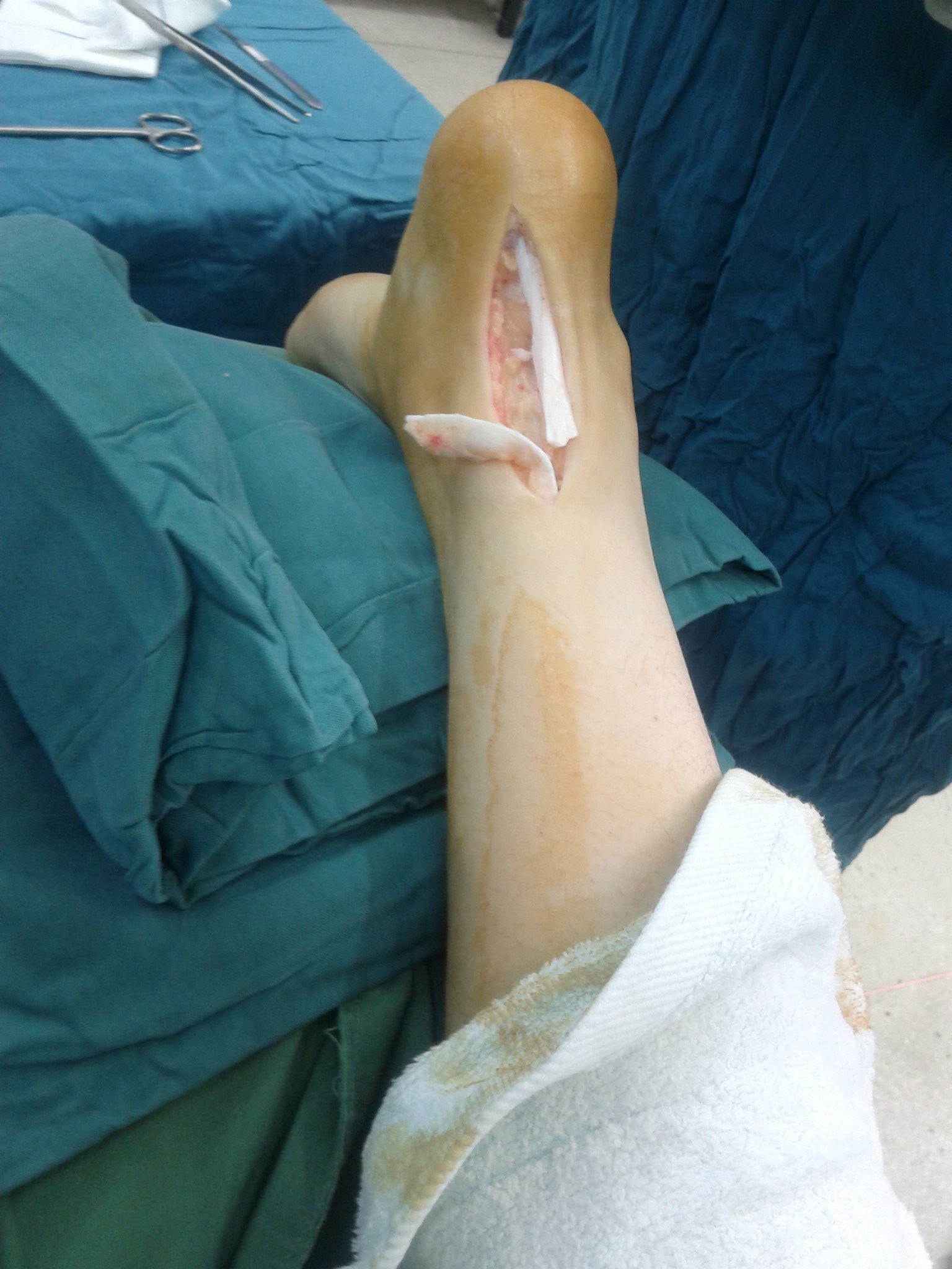 tendon, body part, human hand, achilles, injury, 1080P, recovery, human limb, human leg, low section, pain, physical injury, leg, indoors, rupture, bed, Phone HD Wallpaper