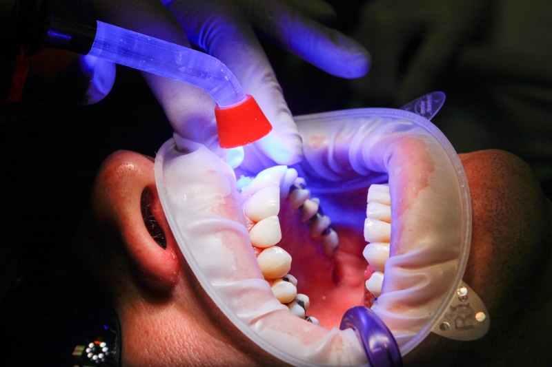 treatment, uv lamp, teeth, indoors, holding, finger, food and drink, table, clinic, mouth, close-up, healthcare And Medicine, person, food, facet, people