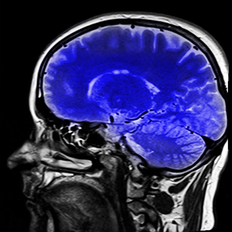 brain, technology, hospital, medical Scan, mRI Scan, x ray, illness, medical x-ray, human, science, tomography, bone, magnetic resonance imaging, x-ray Image