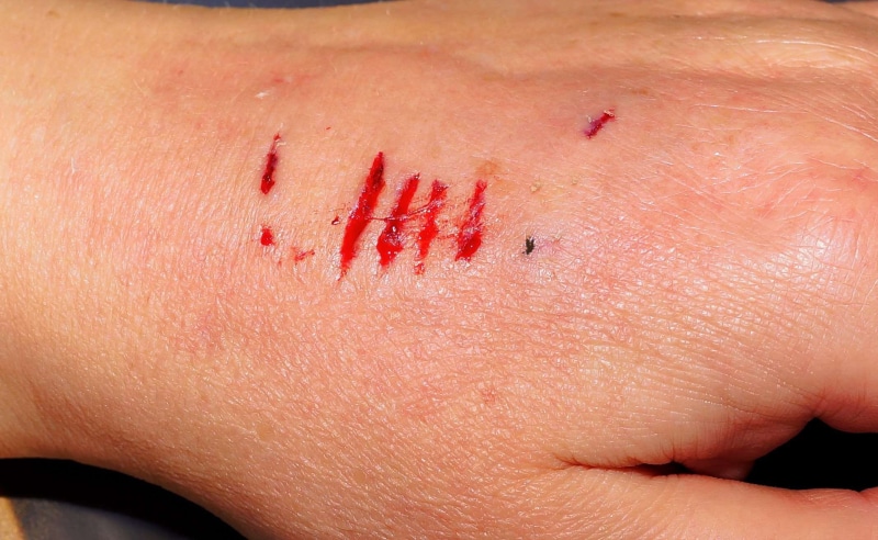 deep scratches, human skin, injured, skin, human blood, physical injury, misfortune, blood, real people, hand, human body part, red, human limb, wounding