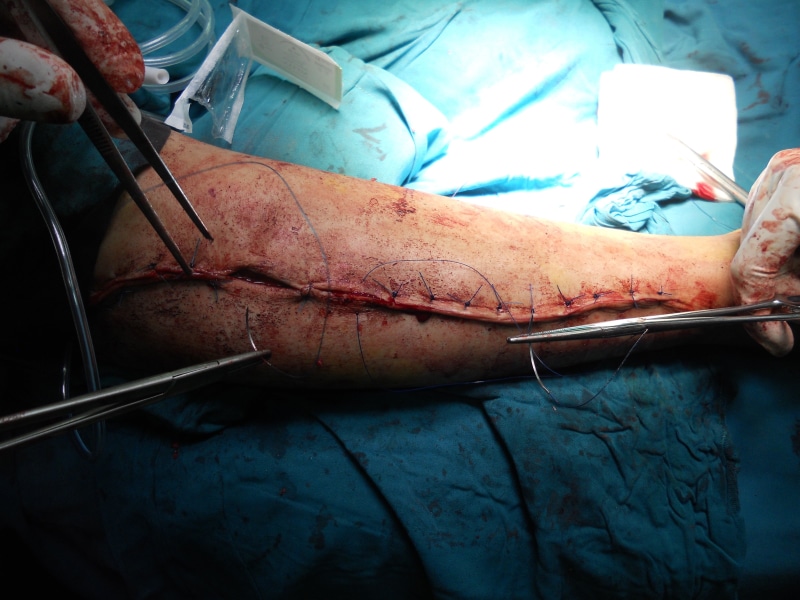 medical procedure, men, healthcare, human body part, human hand, surgeon, orthopedic, medical equipment, surgical glove, medicine, surgery, stitched, arm