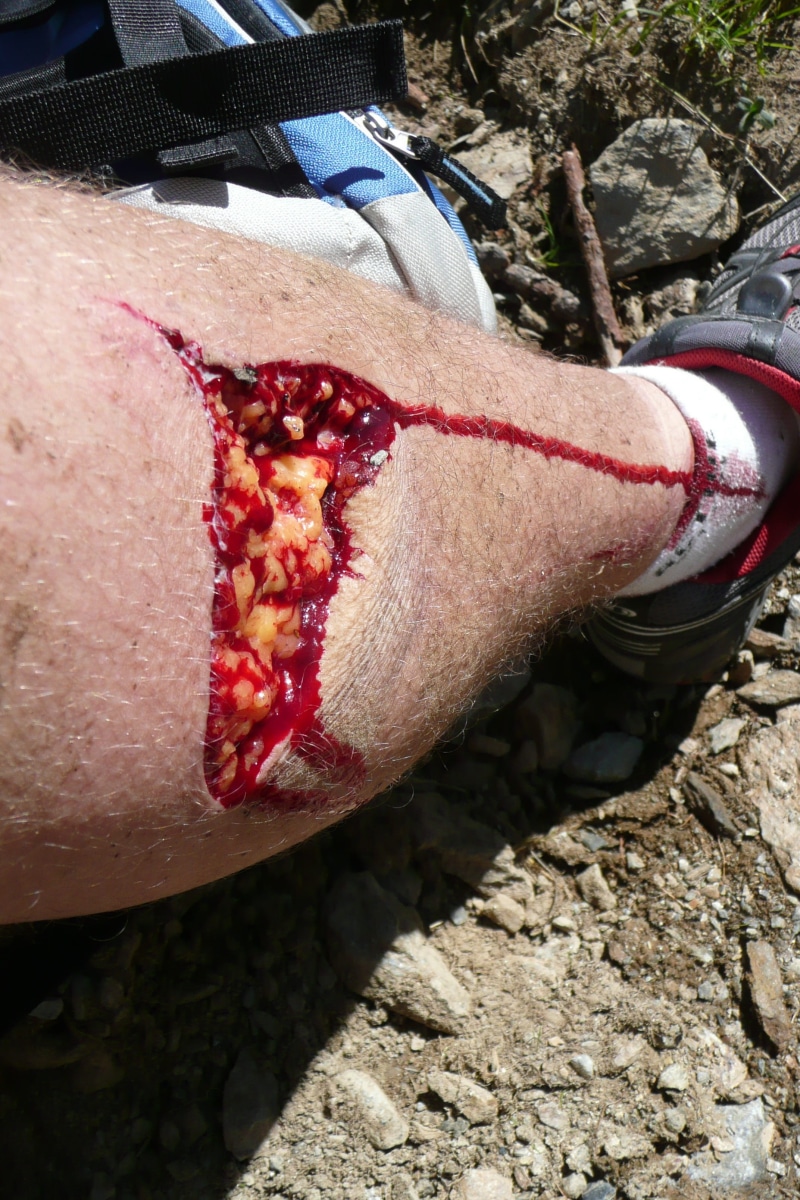 pain, outdoors, injury, nature, bleed, red, human body part, real people, flesh wound, sunlight, day, close-up, damaged, accident, hand, messy, open wound