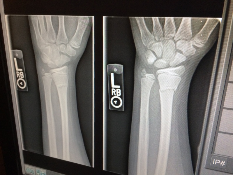 human, medical x-ray, x-ray, x-ray image, no people, clinical, human representation, 2K, health, arm, body, menswear, close-up, medical equipment, black