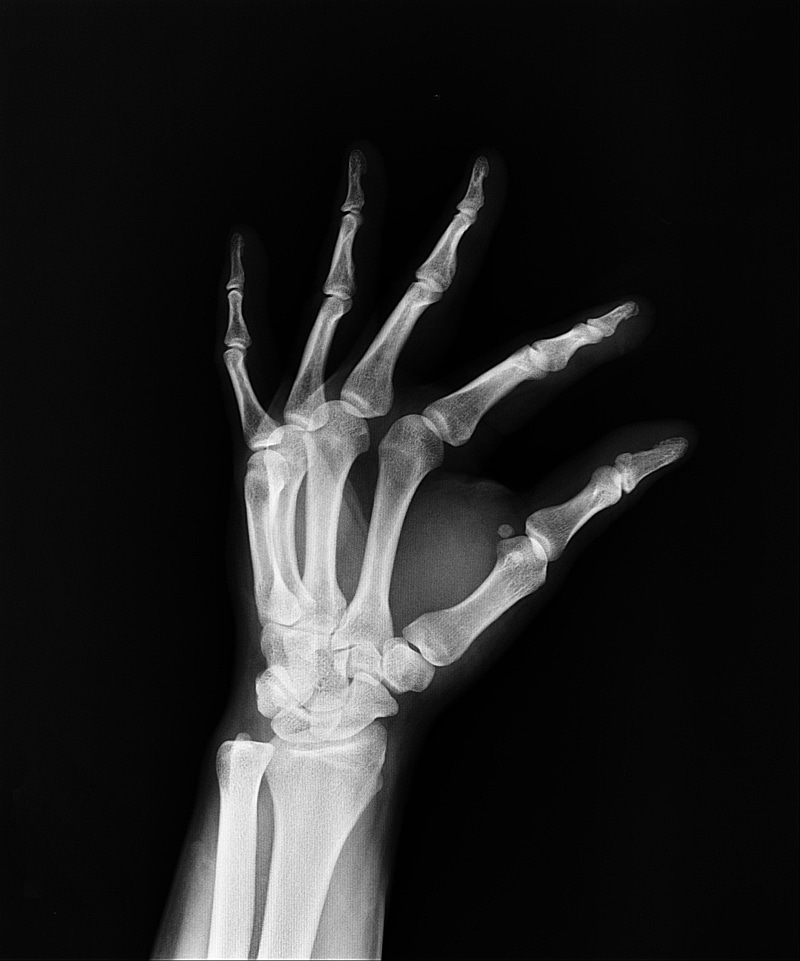 technology, medical insurance, medicine, x, limb, finger, hand, diagnosis, health, medical x-ray, arm, human finger, human bone, 5K, doctors, human joint