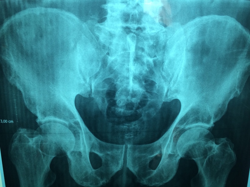 medical condition, illustration, Physician, X Ray, diagnosis, Doctor, patient, body part, x-ray image, film, fracture, hip, medical exam, healthcare and medicine