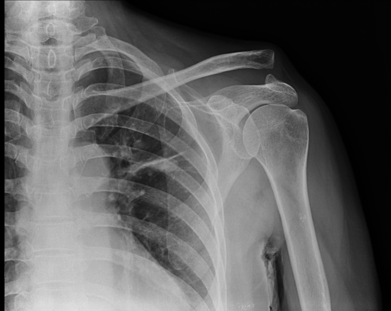 result, x-rays, ray, black background, human body part, human arm, indoors, medical x-ray, medical exam, medicine, medical condition, hospital, anatomy