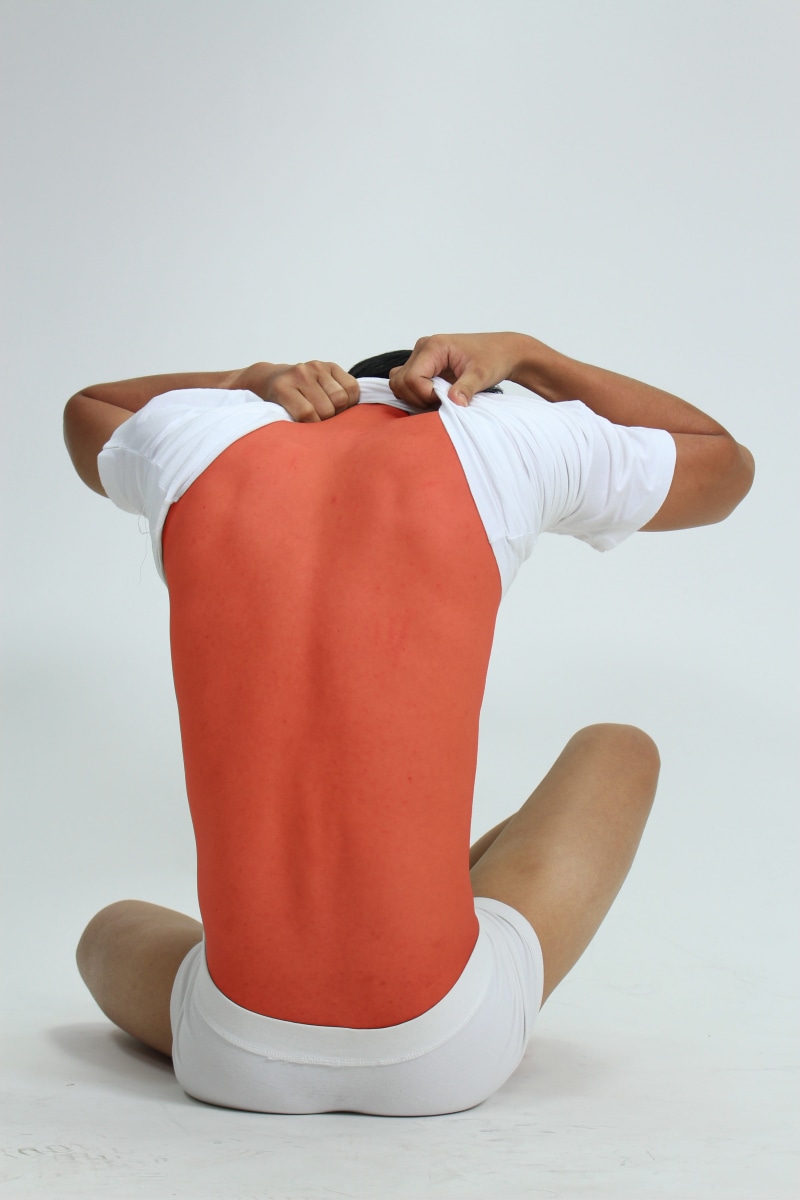 dermatology, red, pain, protection, health, adult, one person, relaxation, sunscreen, back, gray, burn, real people, leisure activity, studio shot, full length