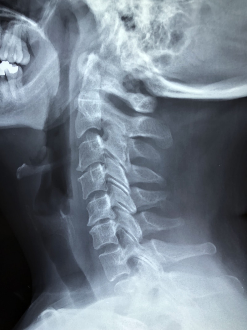 fracture, x-ray, 4K, medical procedure, bone, medical x-ray, anatomy, human skeleton, patient, x-ray image, vertebrae, medical condition, technology, close-up