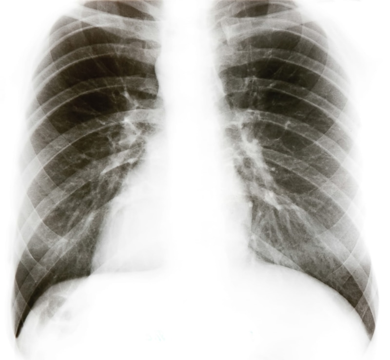 human limb, x-ray, body, examination, studio shot, chest, fracture, clinic, film, human bone, healthy lifestyle, x-ray image, radiology, doctor, anatomy
