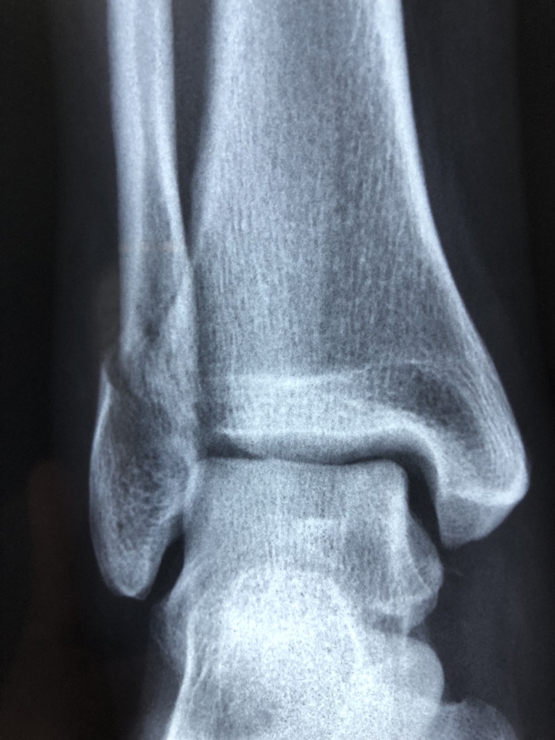 human knee, medical x-ray, doctor, x, medical condition, human body part, human joint, health, people, limb, healthcare and medicine, human limb, black background