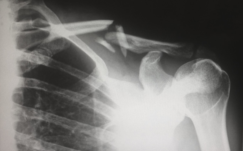 x, limb, body part, black background, x-ray, healthcare and medicine, x-ray image, skeleton, medical exam, human arm, shoulder, human bone, human body part