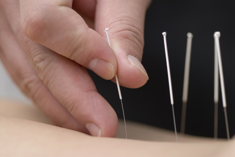 hands, skin, 4K, fingers, needles, acupuncture