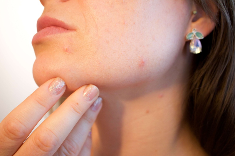 acne, finger, human face, blackhead, beauty, care, body part, chick, annoying, bothersome, disease, cosmetic, complexion, real people, 4K, emergency, one person