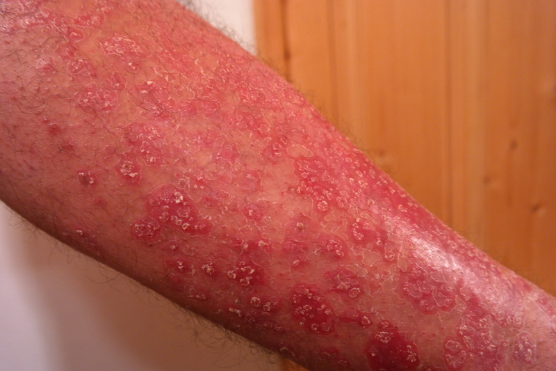 food and drink, disease, juicy, focus on foreground, blood, red, psoriasis, human body part, condition, freshness, 5K, keratinization, people, skin, wellbeing