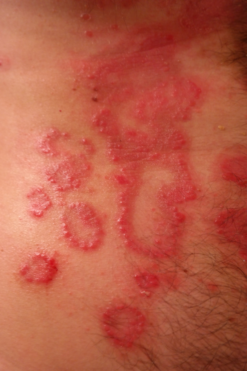 pain, system disease, pink color, red, inflammation, people, healthcare and medicine, textured, blood, Rash, Reddish, bruise, close-up, linsenförmig, 5K
