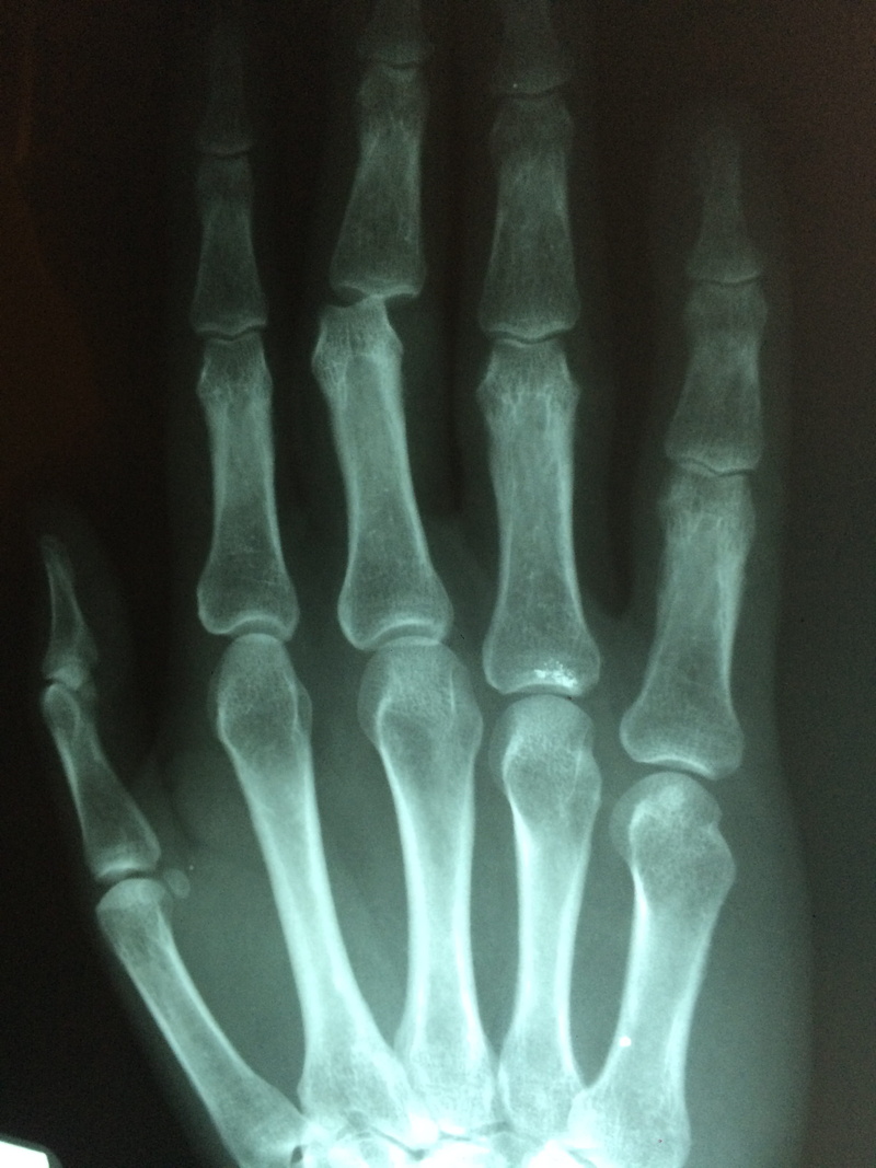 patient, wrist, broken, medical x-ray, pain, biology, fracture, medicine, doctor, healthcare and medicine, hospital, medical exam, human skeleton, physical