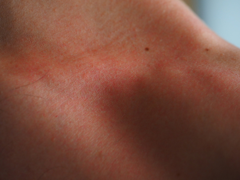 human limb, pain, red, flushed, shirtless, adult, heat, human face, sunburn, extreme close-up, risk, burned, human body part, unrecognizable person, lifestyles