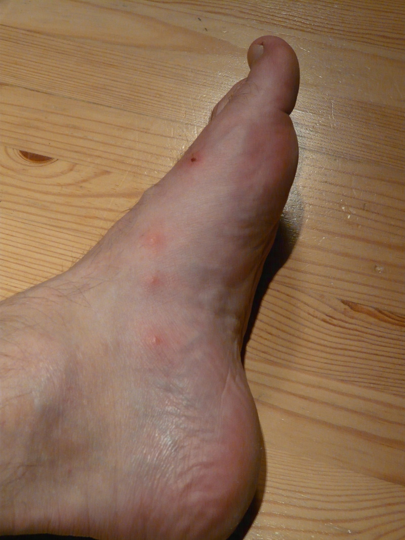 high angle view, human leg, wood grain, physical injury, histamine, warty, indoors, men, personal perspective, finger, one person, real people, human skin