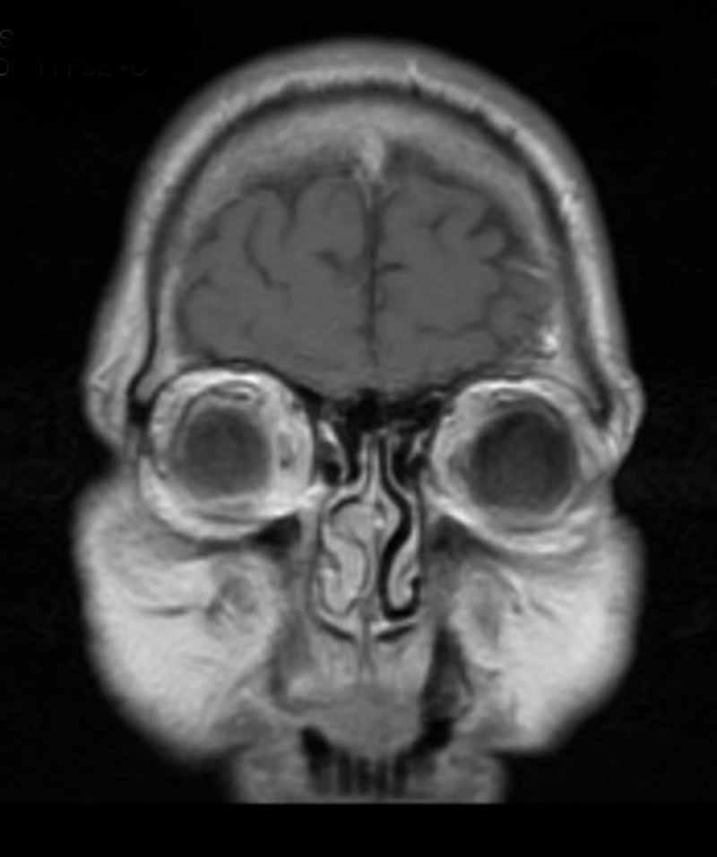 anatomy, brain, medical, head, studio shot, human representation, medical x-ray, magnetic, indoors, mri, people, healthcare and medicine, demyelinating