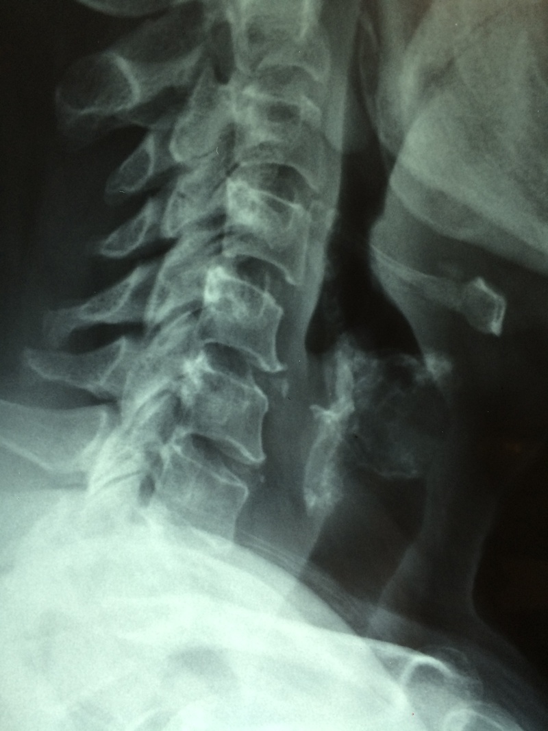 disease, fracture, human face, closeup, health, patient, examination, human, x-ray, neck, human skeleton, physician, doctor, human bone, diagnose, body part