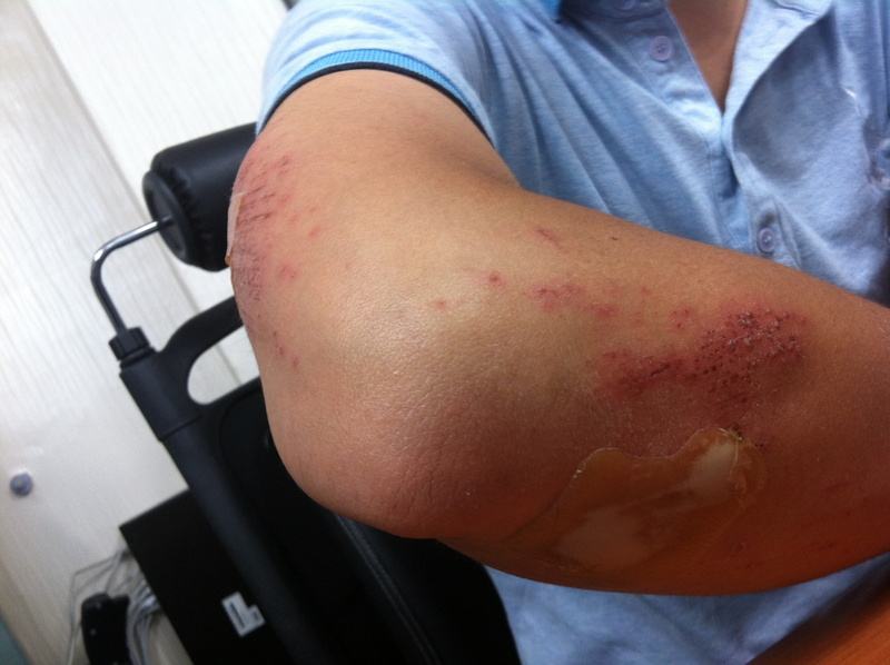 one person, human body part, indoors, bruise, physical injury, healthcare and medicine, emergency, condition, bruising, human, human leg, midsection, ache