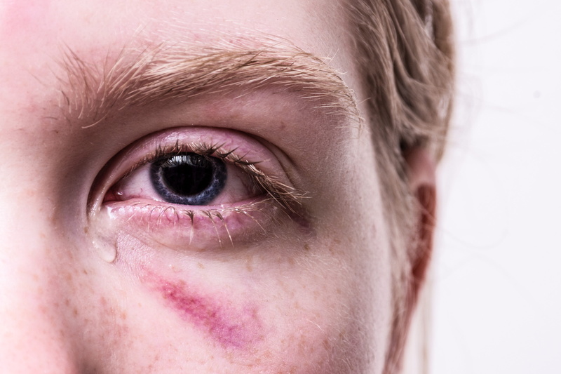 violent, pain, trauma, close-up, eyelash, haematoma, injured, cry, tear, traumatized, sensory perception, men, adult, tormented, bruise, teenager, human face