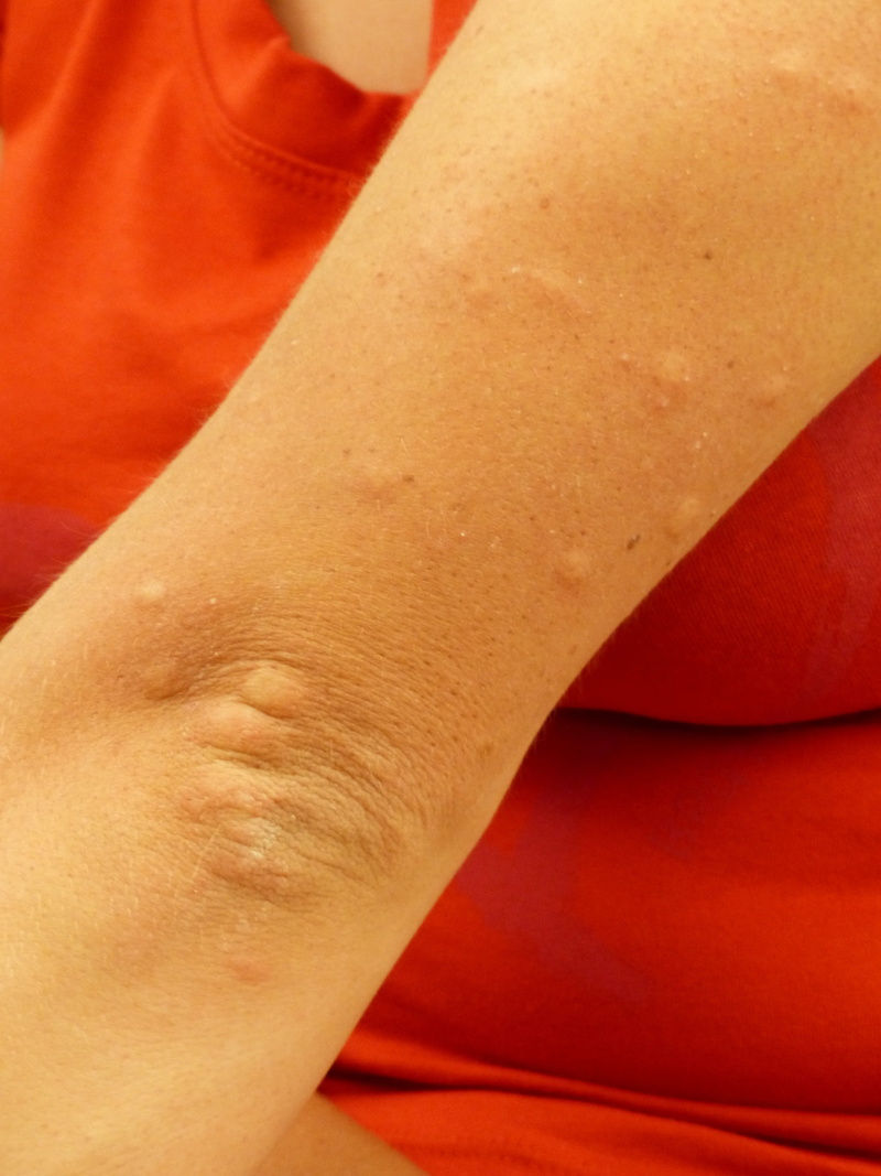 closeup, indoors, 4K, human foot, human leg, limb, immune response, allergic reaction, men, swelling, one person, Bites, Stitches, redness, person, arm