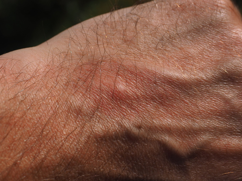 human limb, mosquito bites, fist, unrecognizable person, human hair, redness, s, hair, skin, stitches, wheal, injection site, irritation, men, human skin