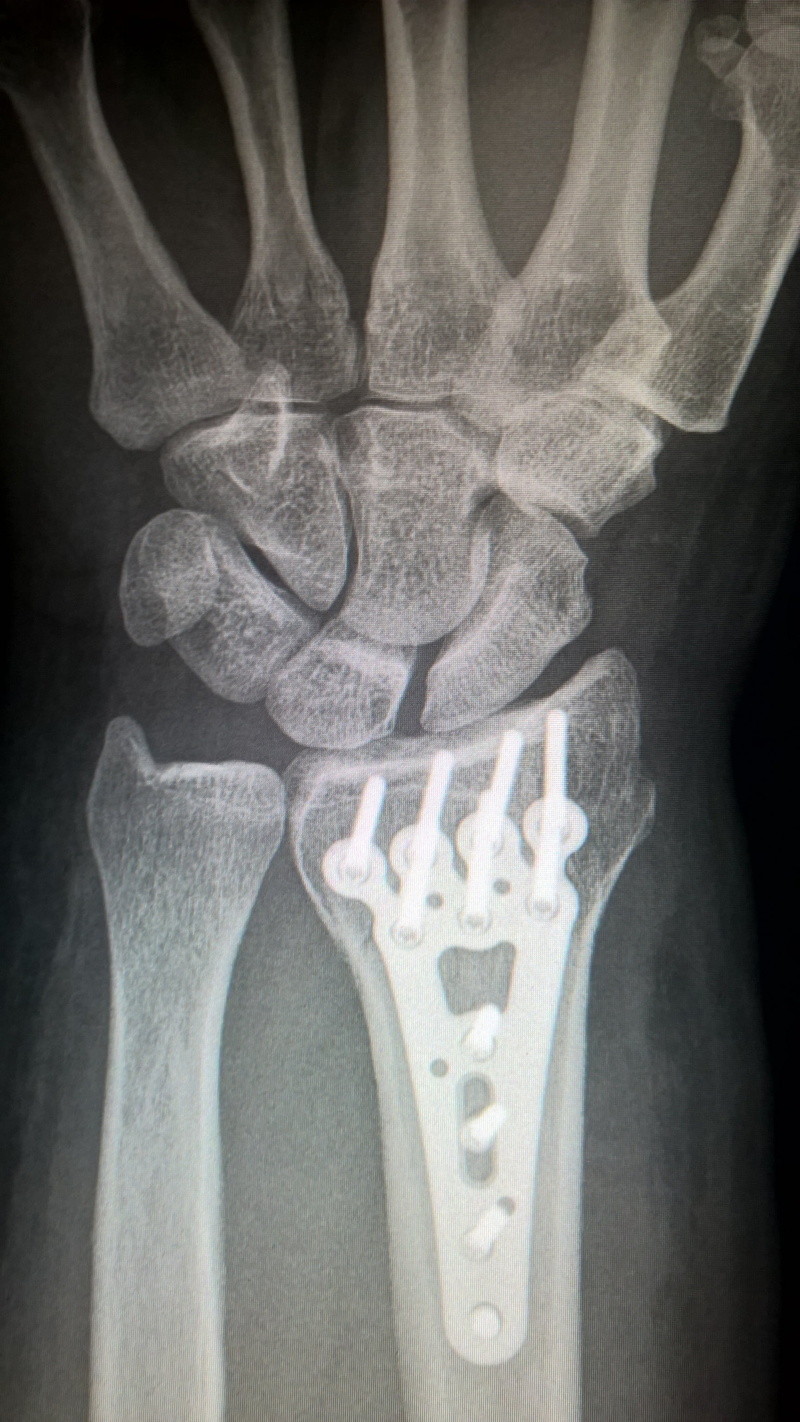 titanium plate, trauma surgery, human Bone, arm, fracture, healthcare and medicine, 2K, human arm, human body part, fracture of radius, x-ray image, plate fixation