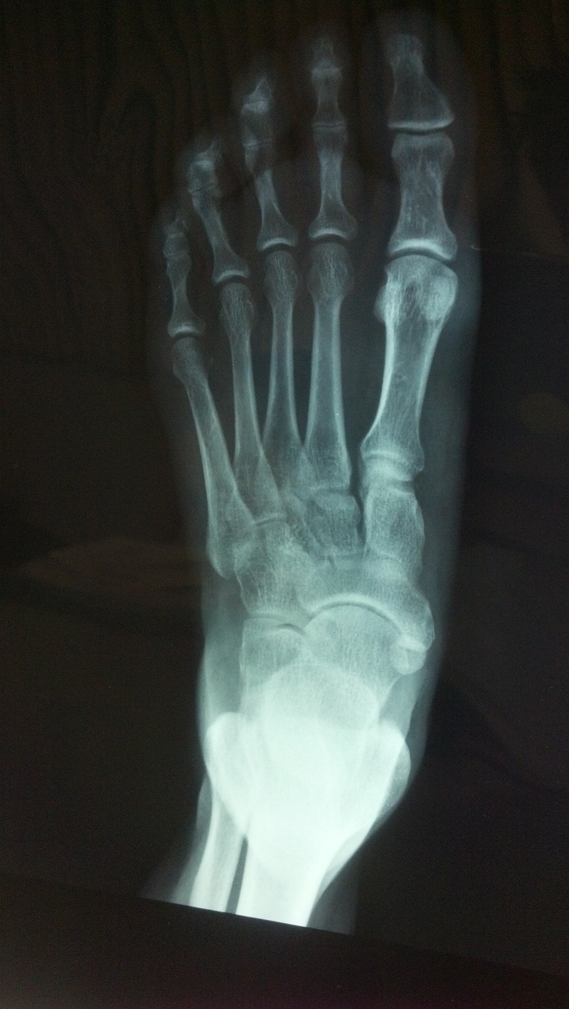skeleton, human finger, indoors, x ray, people, left, x-ray image, medical exam, human hand, human arm, science, hand, foot, fracture, x, bone, ray, body part