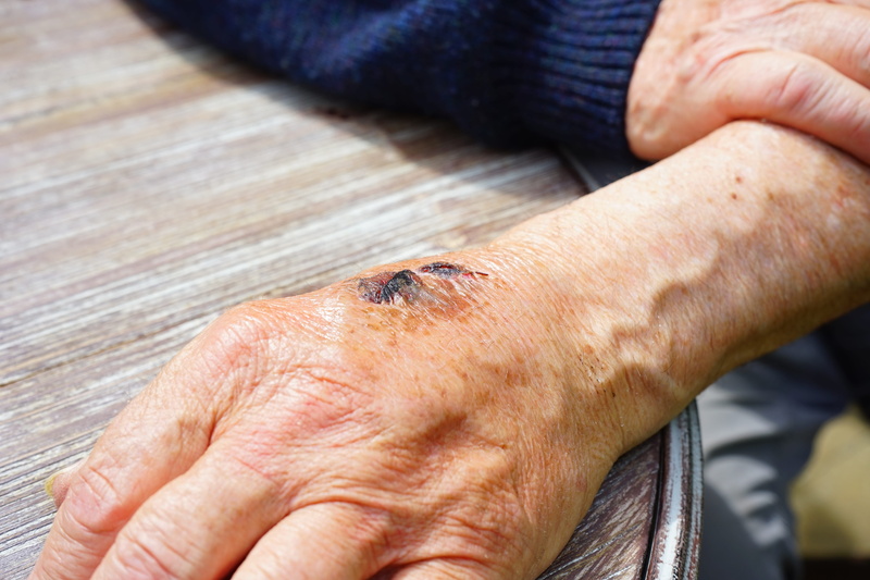 wounding, one person, lifestyles, veins, human hand, scar, human skin, hand, injury, wrinkled, condition, healing, accident, bloody, human body part, senior adult
