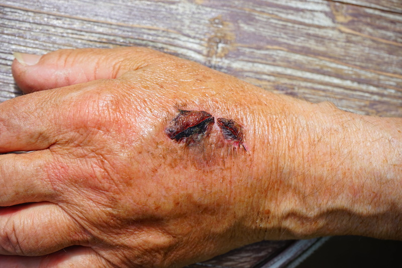 senior adult, blood, hand, care, human skin, people, gall, human hand, 5K, close-up, human, medical condition, physical injury, bruise, wounding, crack